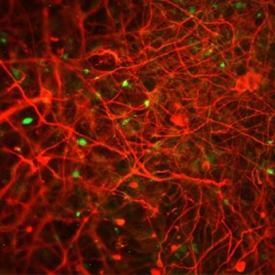 Red flourescence shows Alzheimer plaques in human stem cell derived neurons